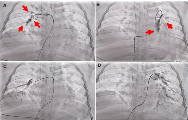 Vier Pulmonalisangiografie-Aufnahmen im Herzkatheterlabor: oben vor dem Eingriff Kontrastmittelaussparungen in der rechten und linken Pulmonalarterie (rote Pfeile), unten nach der Thrombektomie wieder kontrastierte Lappen- und Segmentarterien