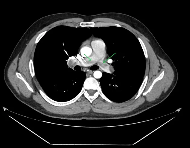 Axiales CT des Thorax mit Kontrastmittel in Höhe der Aufzweigung der Lungenarterie: in beiden Hauptästen liegen dunkle Aussparungen im hellen Kontrastmittel; zwei grüne Pfeile aus dem Original zeigen darauf