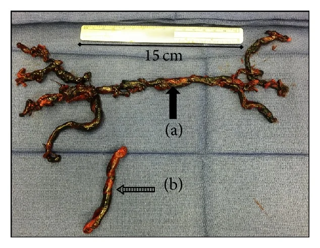 Foto eines auf einem blauen OP-Tuch ausgebreiteten, verzweigten, dunkelroten Thrombus-Ausgusses der Pulmonalarterien (Pfeil a) unter einem Maßstab von 15 cm; darunter ein weiteres längliches Thrombusstück (Pfeil b)