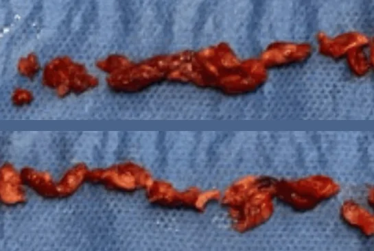 Rote, weiche und brüchige Thrombusstücke auf blauem OP-Tuch, als langer Strang in zwei Reihen gelegt