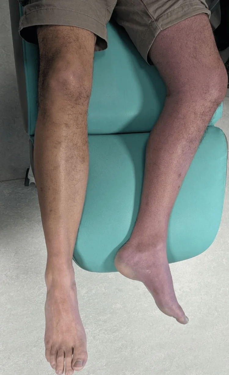Ein Mann sitzt mit beiden Beinen auf einer Untersuchungsliege; ein Bein ist vom Oberschenkel bis zum Fuß deutlich geschwollen und blau-violett verfärbt, das andere Bein hat normale Hautfarbe
