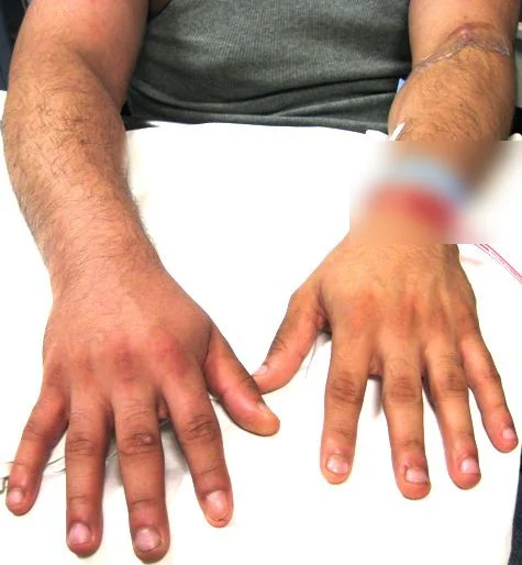 Ein Mann legt beide Unterarme und Hände nebeneinander auf eine weiße Unterlage; der im Bild linke Arm und die Hand sind geschwollen und leicht gerötet, die Finger wirken verdickt; am anderen Handgelenk ist ein Bereich unscharf gemacht