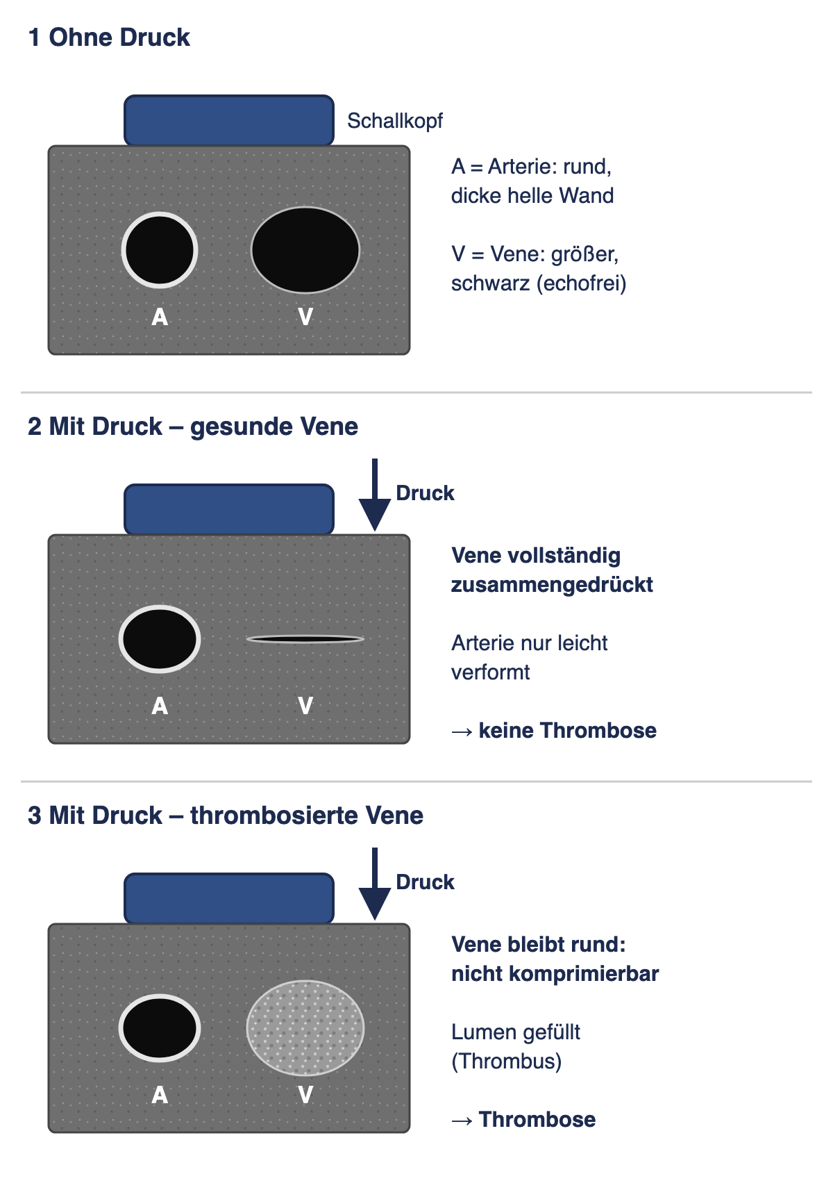 Drei untereinander angeordnete schematische Ultraschall-Querschnitte mit Schallkopf, runder Arterie A und größerer Vene V: ohne Druck beide offen; mit Druck gesunde Vene zu einem Strich zusammengedrückt; mit Druck thrombosierte Vene rund und mit grauem Material gefüllt