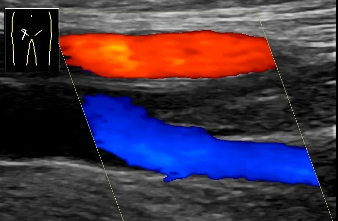 Farbduplex-Ultraschall im Längsschnitt am Oberschenkel: oben ein rot gefülltes Gefäß, unten ein blau gefülltes Gefäß, dazwischen ein graues Gefäß ohne Farbsignal; links oben ein kleines Körperpiktogramm zur Schallkopfposition