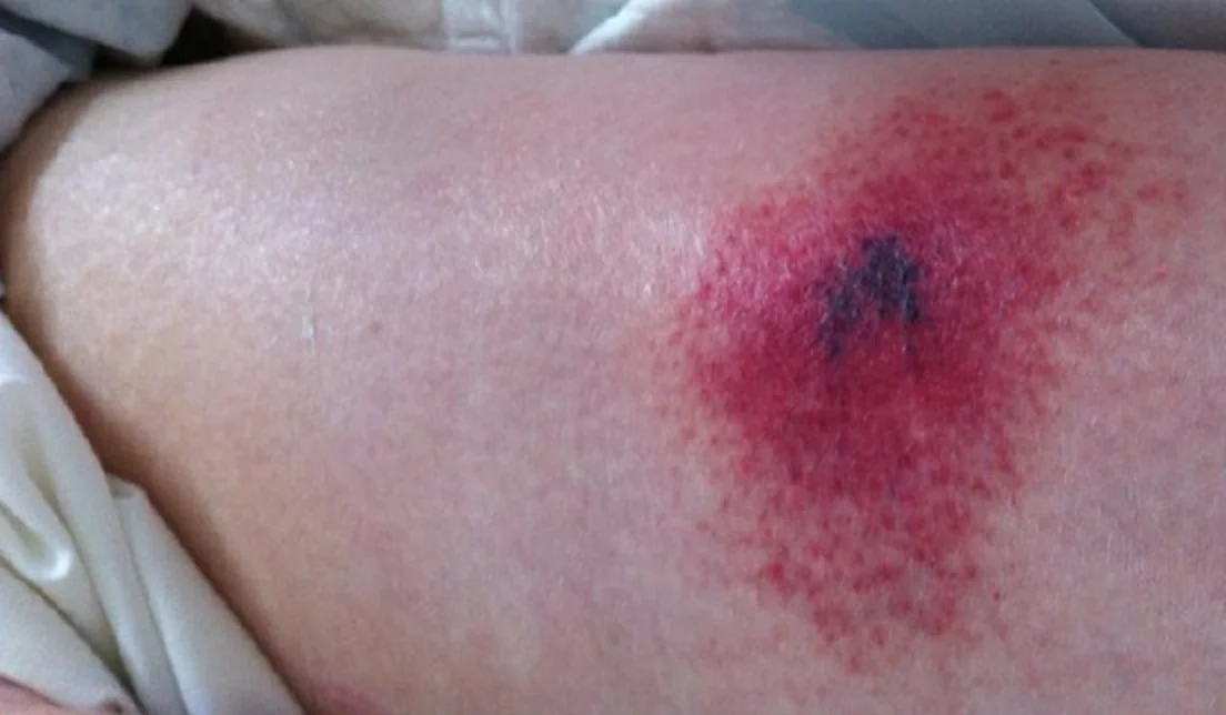 Foto eines Oberschenkels: um eine Heparin-Einstichstelle eine unscharf begrenzte, fleckige Rötung mit kleinen roten Pünktchen am Rand und einem zentralen blauschwarzen Nekroseherd