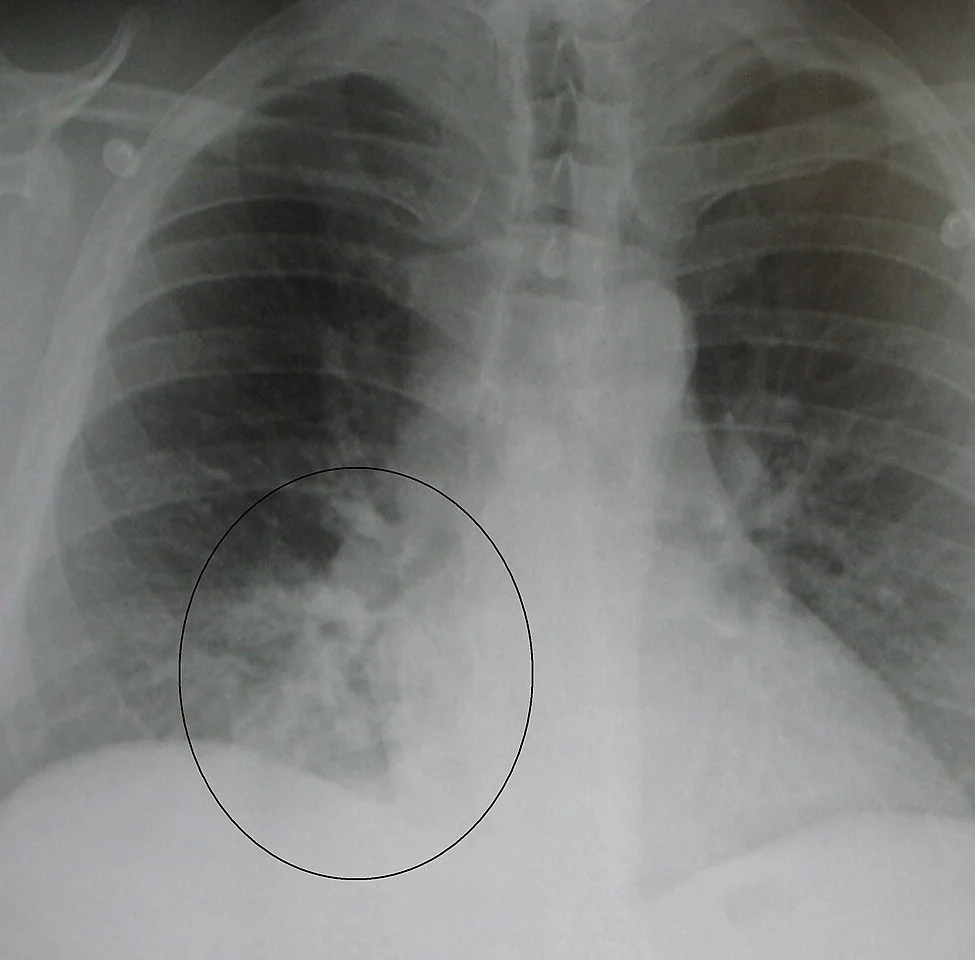 Abfotografierte frontale Thoraxaufnahme: rechts basal (im Bild links unten) eine unscharf begrenzte, fleckige Verschattung neben dem Herzrand; ein dünner schwarzer Kreis umrandet den Bereich.
