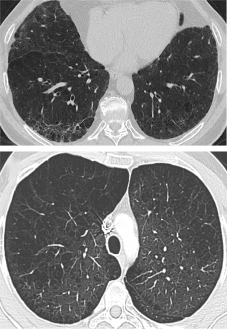Zwei axiale CT-Schnitte im Lungenfenster: oben fibrotischer Umbau mit basal und subpleural betonter netzartiger Zeichnung und Traktionsbronchiektasen, unten konfluierendes zentrilobuläres Emphysem mit großflächig verminderter Dichte und spärlichen Gefäßen.