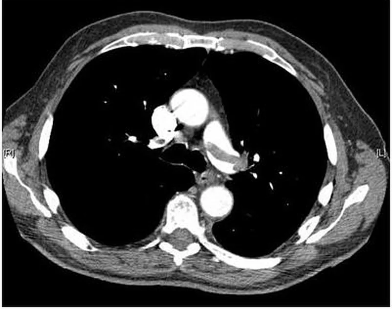 Axiales CT des Thorax nach intravenösem Kontrastmittel im Weichteilfenster: hell kontrastierte Gefäße im Mediastinum; in der linken Pulmonalarterie (im Bild rechts) liegt eine graue Aussparung im hellen Gefäßlumen.