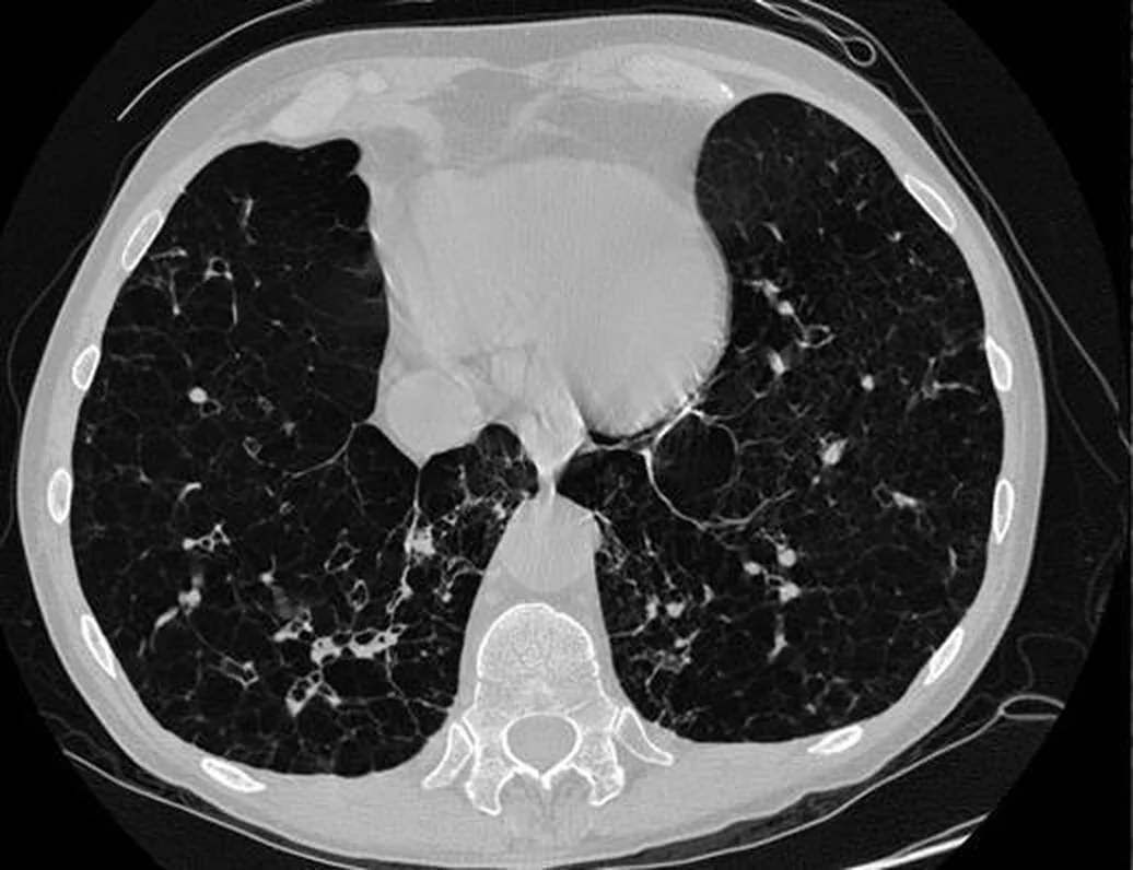 Axiales CT-Bild des Thorax im Lungenfenster mit großflächig sehr dunklen, strukturarmen Lungenarealen und nur wenigen verbliebenen Gefäßen.