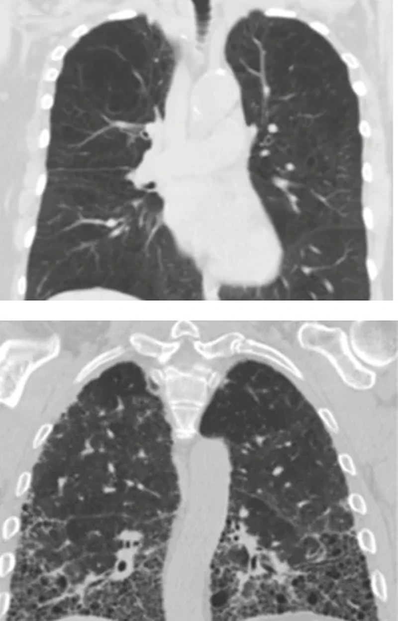 Zwei koronare CT-Schnitte im Lungenfenster untereinander: oben rarefizierte Gefäße und Septen bei Emphysem, unten retikuläre Verdichtungen und Honigwabenmuster bei Lungenfibrose, basal und subpleural betont.