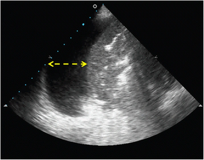 Thoraxsonografie mit dunklem, echoarmem Flüssigkeitssaum zwischen Thoraxwand und Lunge; ein gelber gestrichelter Doppelpfeil markiert dessen Breite.