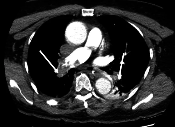 Axiale CT-Pulmonalisangiografie: Pfeile zeigen auf Kontrastmittelaussparungen in Pulmonalarterienästen beider Seiten.