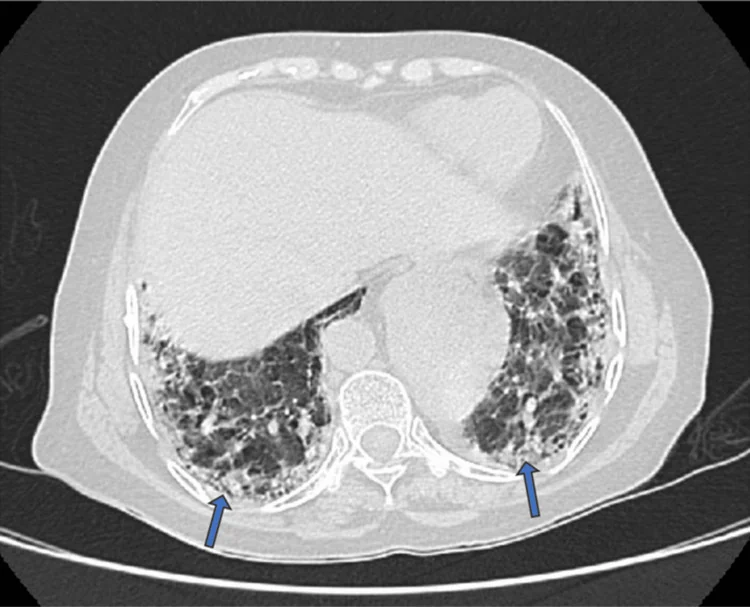 Axiales CT des Thorax im Lungenfenster auf Höhe der Lungenbasen: beidseits unter der Pleura grobe netzartige Verdichtungen mit kleinen Hohlräumen; zwei blaue Pfeile zeigen auf die dorsalen Abschnitte.