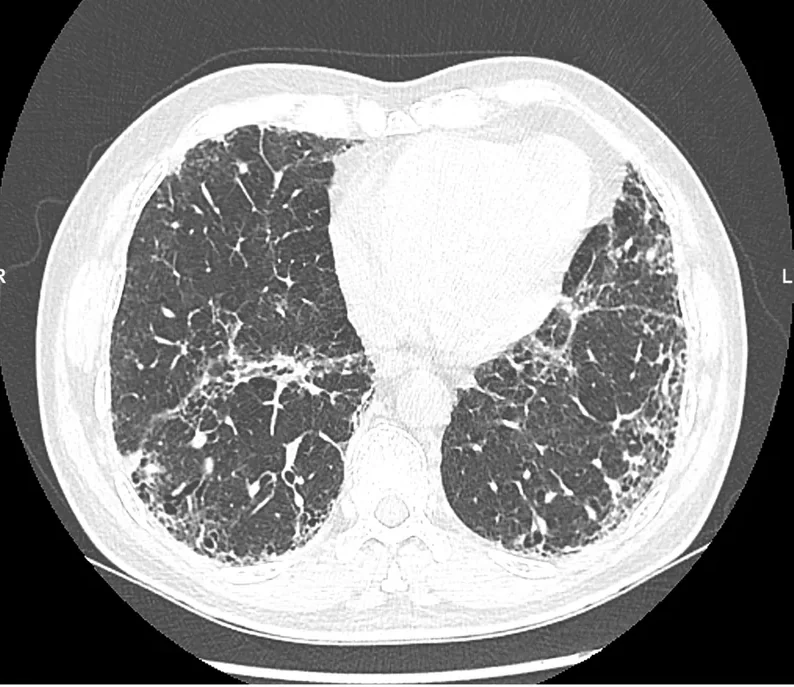 Axiales CT im Lungenfenster auf Herzhöhe: beidseits unter der Pleura betonte netzartige Verdichtungen mit erweiterten, verzogenen Bronchien und kleinen randständigen Hohlräumen, rechts dorsal am deutlichsten.