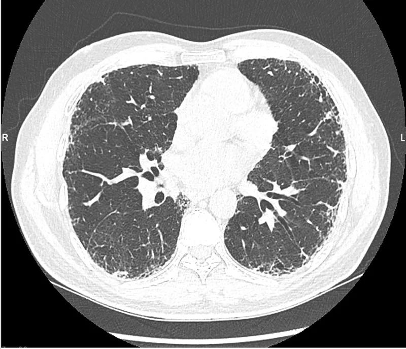 Axiales CT im Lungenfenster auf Höhe der Lungenhili: beidseits feine netzartige Verdichtungen unter der Pleura, vor allem dorsal; zentral belüftetes Lungengewebe mit Gefäßen und Bronchien.