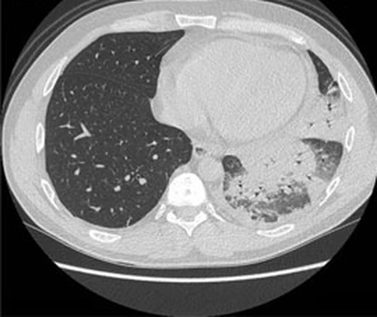 Axiales CT-Bild des Thorax im Lungenfenster mit einem verdichteten Bezirk neben der Wirbelsäule; Aufgabenbild.