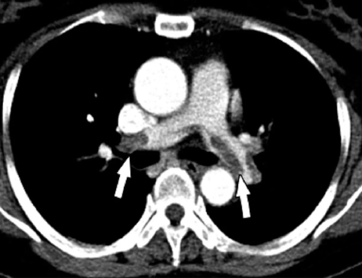 Axiales kontrastmittelverstärktes CT-Bild des Thorax im Weichteilfenster: hell kontrastierte Aorta und Pulmonalarterien, zwei Pfeile zeigen auf dunklere Aussparungen in Lungenarterienästen beider Seiten.