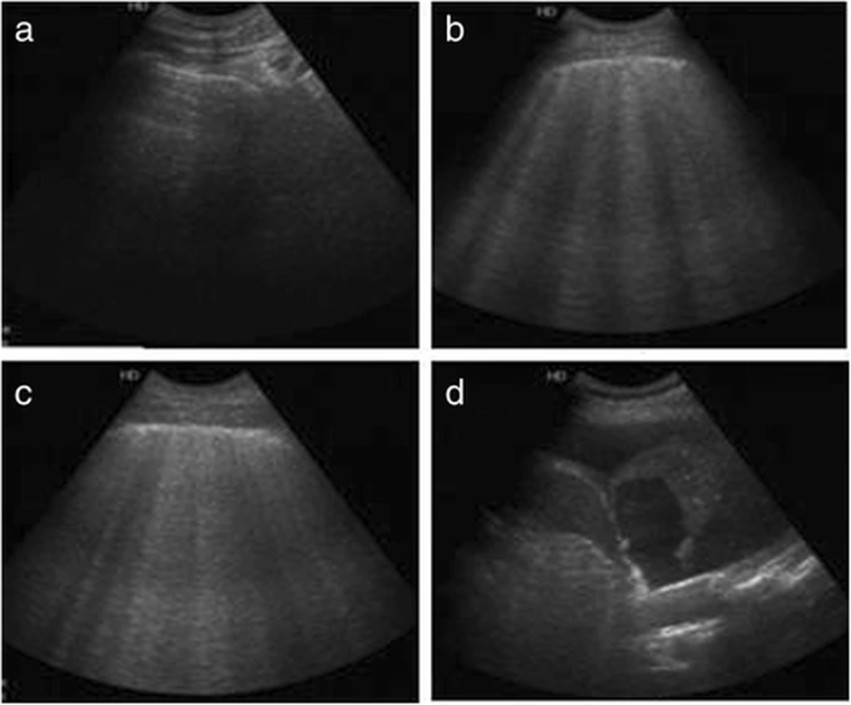 Vier Lungensonografiebilder: a horizontale A-Linien unter der Pleuralinie, b mehrere abgrenzbare B-Linien, c zusammenfließende B-Linien, d gewebeähnliches Muster einer Konsolidierung.