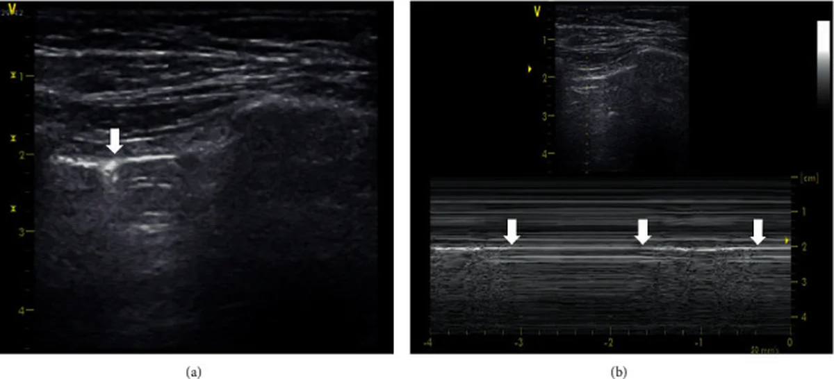 Lungensonografie mit Linearschallkopf: links ein B-Bild, in dem ein senkrechter Pfeil den Übergang von gleitender zu nicht gleitender Pleura markiert; rechts ein M-Modus, in dem Pfeile den Wechsel zwischen körnigem und streifigem Muster markieren.