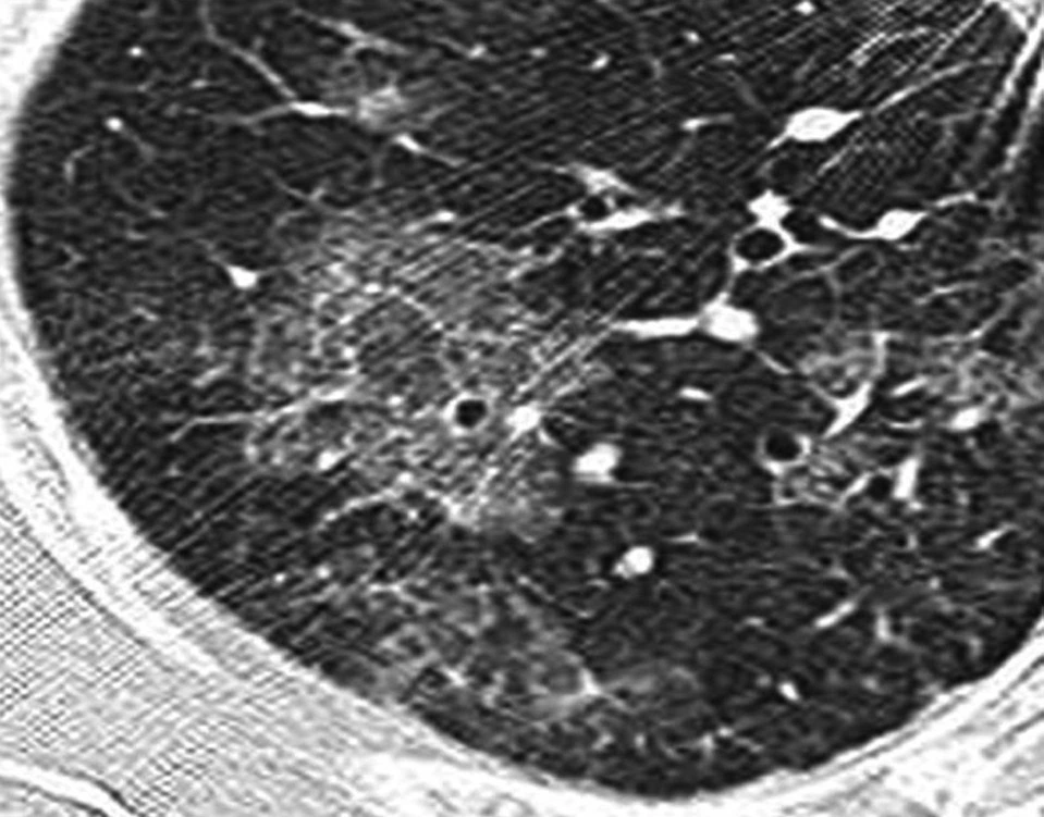 Ausschnitt einer hochauflösenden CT im Lungenfenster mit fleckigen Milchglastrübungen, in denen Gefäße und Bronchuswände sichtbar bleiben.
