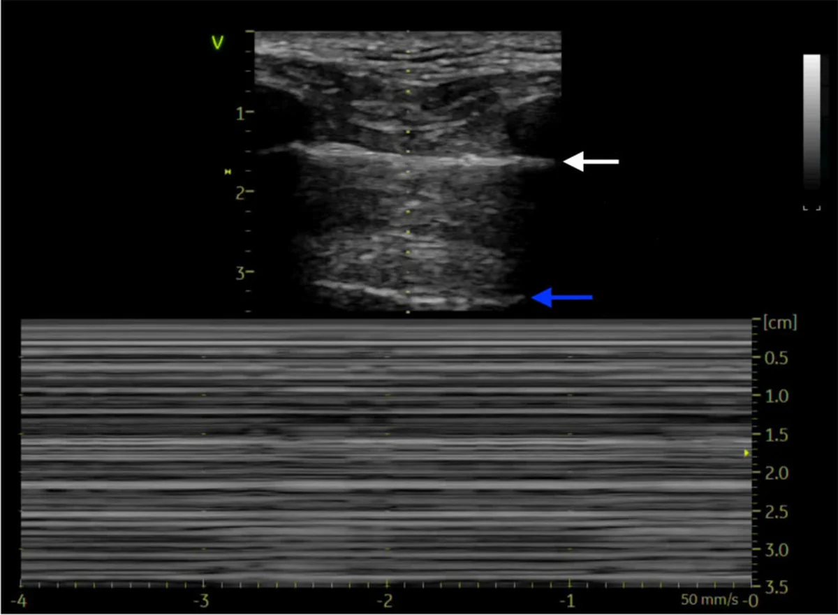 Lungensonografie bei Pneumothorax: oben B-Bild mit heller Pleuralinie (weißer Pfeil) und einer A-Linie darunter (blauer Pfeil), unten M-Modus mit durchgehend horizontalen Linien ober- und unterhalb der Pleuralinie.