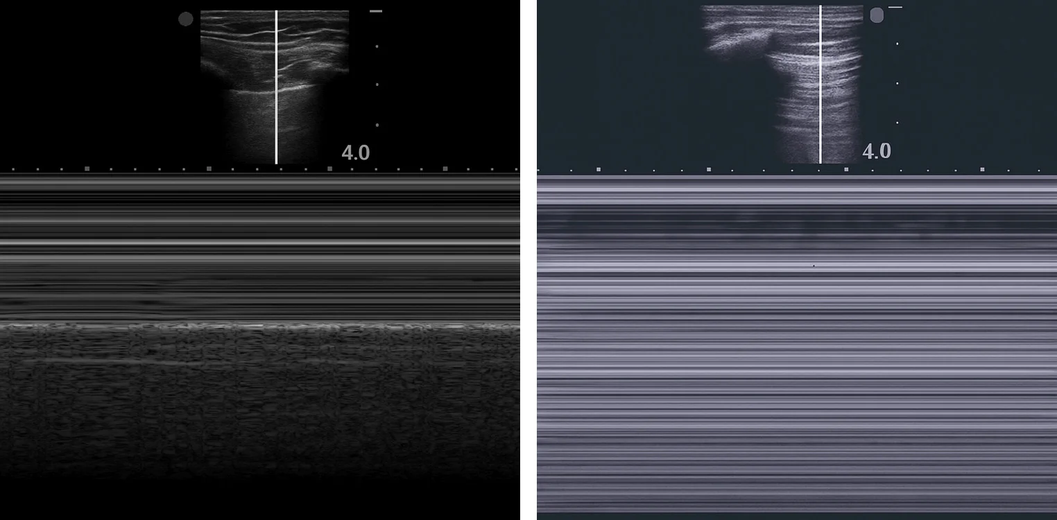 Zwei M-Mode-Aufnahmen der Lunge nebeneinander, jeweils oben das B-Bild mit senkrechter Messlinie: links unterhalb der hellen Pleuralinie ein körniges Muster, rechts über die ganze Bildtiefe nur waagerechte Linien.