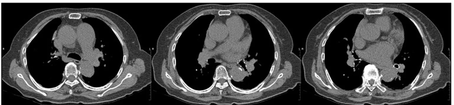 Drei axiale CT-Schichten des Thorax ohne Kontrastmittel im Weichteilfenster auf Höhe der Pulmonalarterien: Herz, Aorta und Pulmonalarterien erscheinen einheitlich grau, die Lungen schwarz.