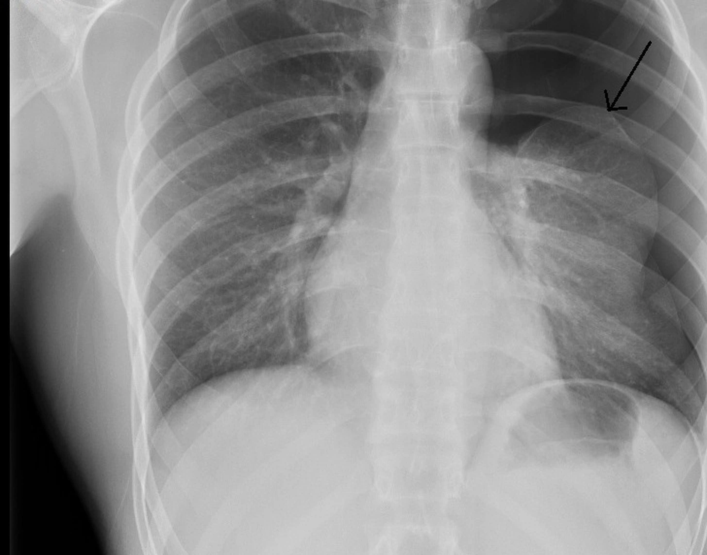 Frontale Thoraxaufnahme in Exspiration bei linksseitigem Pneumothorax; ein Pfeil zeigt auf die viszerale Pleuralinie im linken Oberfeld.