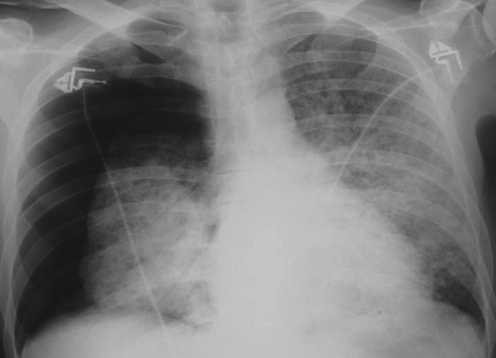 Frontale Thoraxaufnahme eines Patienten mit akuten rechtsseitigen Thoraxschmerzen; Aufgabenbild ohne Markierung.