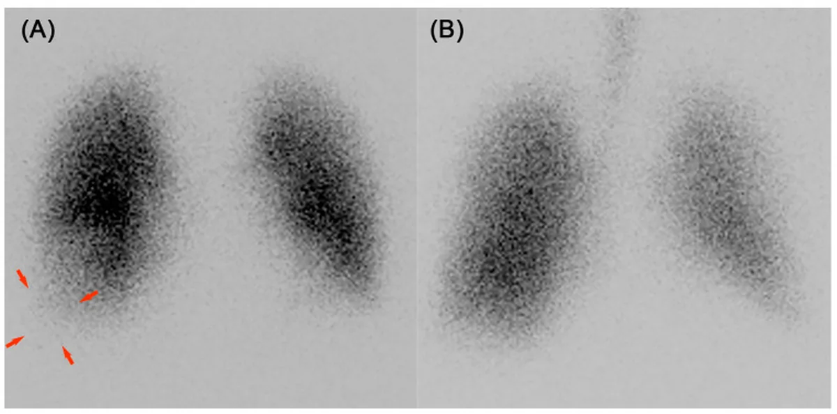Zwei planare Lungenszintigrafie-Aufnahmen von vorn nebeneinander: links Perfusion mit fehlender Aktivität rechts basal (rote Pfeile), rechts Ventilation mit an dieser Stelle erhaltener Aktivität.