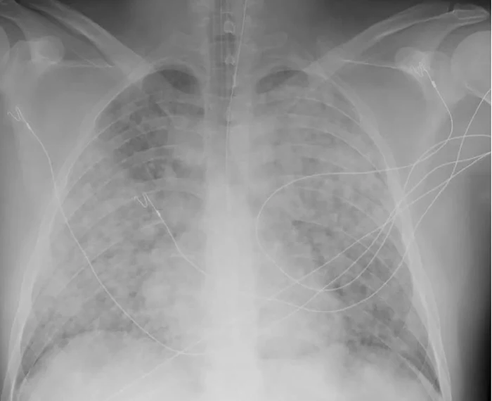 Röntgen-Thorax im Liegen bei einem intubierten Patienten: Tubus in der Trachea, mehrere Überwachungskabel; in beiden Lungen ausgedehnte, fleckig bis flächig zusammenfließende Verschattungen bis in die Unterfelder.