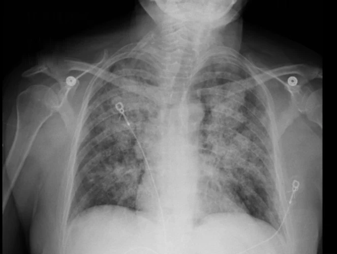Röntgen-Thorax im Halbsitzen: in beiden Lungen diffuse, fleckig-netzartige Verschattungen in allen Feldern; Herzrand teilweise unscharf; EKG-Elektroden auf Brust und Schultern.