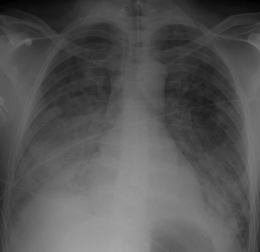 Röntgen-Thorax eines Intensivpatienten mit beidseitigen, fleckig bis flächig zusammenfließenden Verschattungen in beiden Lungen, betont in den mittleren und unteren Feldern; Herzkontur teilweise unscharf; am Bildrand Überwachungselektroden.
