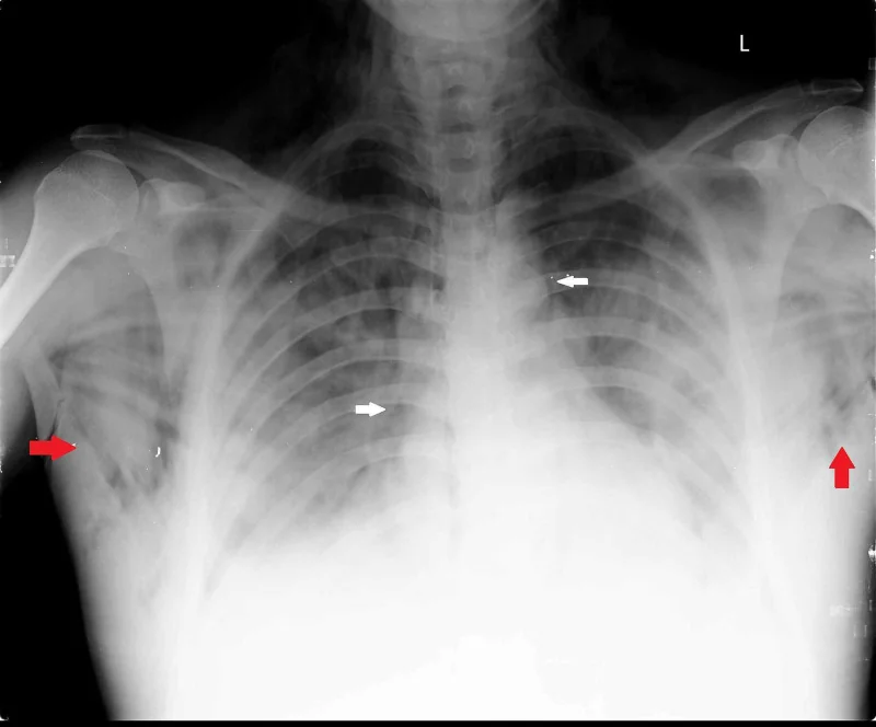 Thoraxröntgen bei beidseitiger Pneumonie mit fleckigen Verschattungen. Rote Pfeile an beiden seitlichen Brustwänden zeigen streifige Luft in den Weichteilen; weiße Pfeile neben dem Mediastinum zeigen Luft entlang des Mittelfells.
