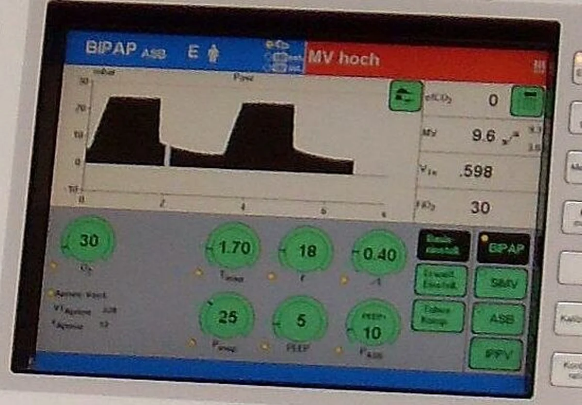 Display eines Intensivrespirators: oben die Modusanzeige BIPAP/ASB und ein roter Alarmbalken „MV hoch“, darunter eine Druck-Zeit-Kurve mit zwei Druckplateaus; unten grüne Einstellfelder, unter anderem O₂ 30, Pinsp 25, PEEP 5 und P ASB 10 mit dem Zusatz „PEEP+“.