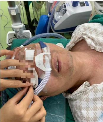 Liegender Patient mit breiter, an den Wangen fixierter Nasenkanüle; ein gerippter Schlauch führt zum Flowgerät im Hintergrund; zwei Hände halten die Fixierung; die Augenpartie ist bereits in der Originalabbildung unkenntlich gemacht.