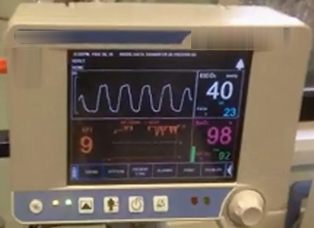 Kapnografiemonitor bei Sedierung: oben eine CO₂-Kurve mit regelmäßigen Ausatemwellen, rechts daneben endtidales CO₂ 40 mmHg und Atemfrequenz 23 pro Minute, darunter SpO₂ 98 % und Puls 92 pro Minute.