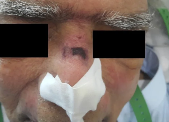 Nasenrücken eines älteren Patienten mit dunkler, scharf begrenzter Druckläsion an der Auflagestelle der Maske; Augenpartie geschwärzt, Pflaster auf der Nasenspitze, grüne Maskenbänder seitlich.