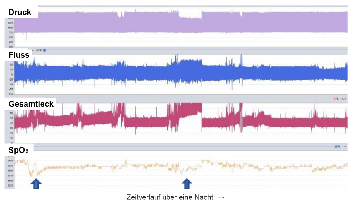 Geräteaufzeichnung einer NIV über eine Nacht mit vier Spuren untereinander: Druck, Fluss, Gesamtleck und SpO₂. Zwei Pfeile markieren SpO₂-Abfälle, die zeitlich mit deutlich erhöhter Leckage zusammenfallen; im mittleren Abschnitt liegt das Leck dauerhaft am oberen Rand und der abgegebene Druck ist niedriger.