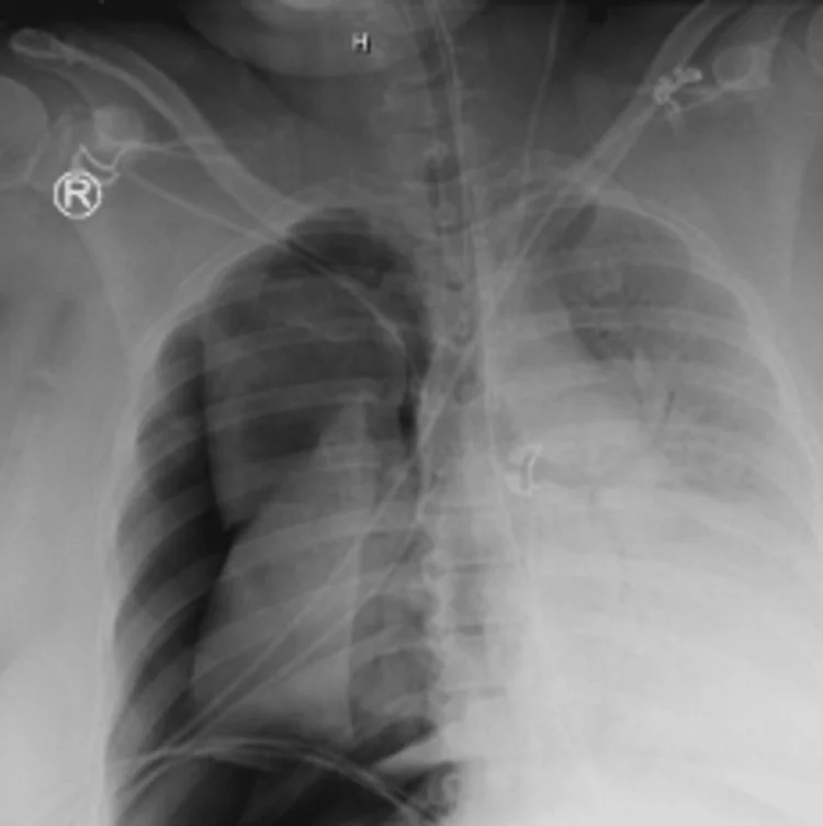 Thoraxröntgen einer invasiv beatmeten Patientin mit Tubus und Leitungen: Die rechte Lunge (im Bild links) ist zum Hilus hin zusammengefallen; außen davon liegt ein dunkler Saum ohne Lungengefäßzeichnung. Die linke Lunge ist dicht verschattet.