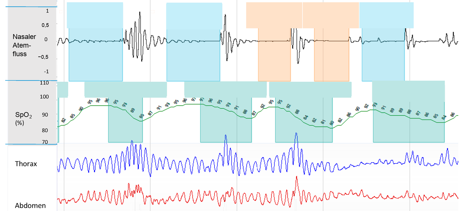 Ausschnitt einer respiratorischen Polygraphie über etwa zweieinhalb Minuten mit den Kanälen nasaler Atemfluss, SpO₂, Thorax- und Abdomenbewegung. In blau und orange markierten Abschnitten ist der Atemfluss stark vermindert oder aufgehoben, während Thorax- und Abdomenkurve weiterlaufen; anschließend fällt die Sättigung ab.