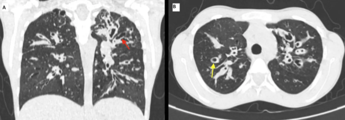 Zwei CT-Bilder nebeneinander, mit A und B beschriftet. A: koronare CT im Lungenfenster; in der linken Lunge, im Bild rechts, verläuft ein erweiterter, röhrenförmiger zentraler Bronchus, markiert mit rotem Pfeil. B: axiale CT der Oberlappen; in beiden Lungen mehrere runde, dickwandige, erweiterte Bronchien nahe am Hilus, im rechten Oberlappen, im Bild links, ein gelber Pfeil.