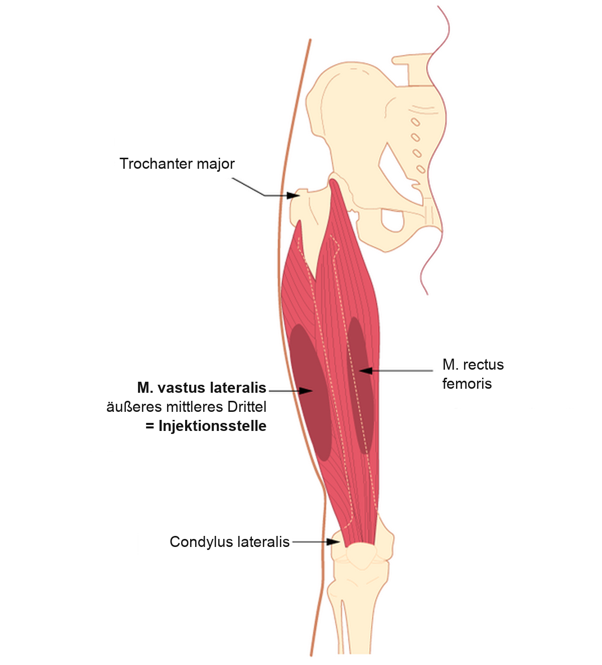 Zeichnung eines rechten Oberschenkels von vorn mit Becken und Knie: Trochanter major oben, Condylus lateralis unten; auf dem äußeren mittleren Drittel des M. vastus lateralis ist die Injektionsstelle als dunkles Oval markiert, ein zweites Oval liegt auf dem M. rectus femoris.
