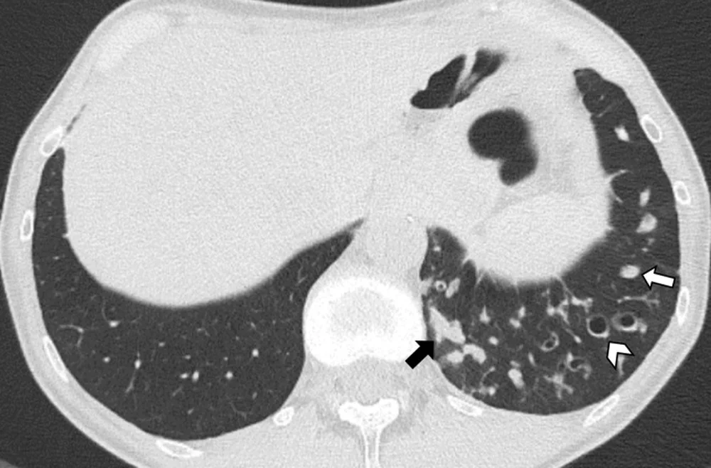 Axiale Dünnschicht-CT des unteren Thorax im Lungenfenster. Im linken Unterlappen, im Bild rechts, liegen mehrere ringförmige, dickwandige Bronchien, die weiter sind als die danebenliegenden Gefäße; dazu tubuläre und knotige weiße Verdichtungen. Die rechte Lunge ist weitgehend unauffällig.