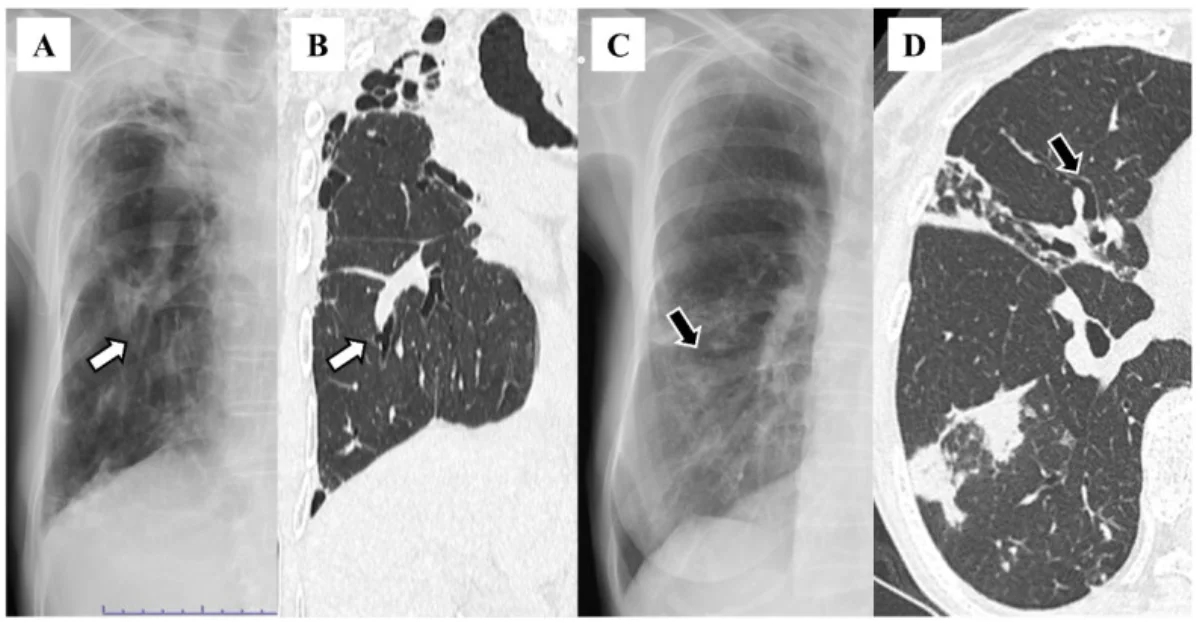 Vier Bildfelder nebeneinander, mit A bis D beschriftet. A: Ausschnitt eines Röntgen-Thorax der rechten Lunge; ein weißer Pfeil zeigt auf zwei parallel laufende helle Linien. B: koronare CT derselben Person im Lungenfenster; der weiße Pfeil zeigt auf einen deutlich erweiterten, dickwandigen Bronchus. C: Röntgen-Ausschnitt mit einem ringförmigen Schatten, schwarzer Pfeil. D: axiale CT mit einem ringförmig erweiterten Bronchus, schwarzer Pfeil.
