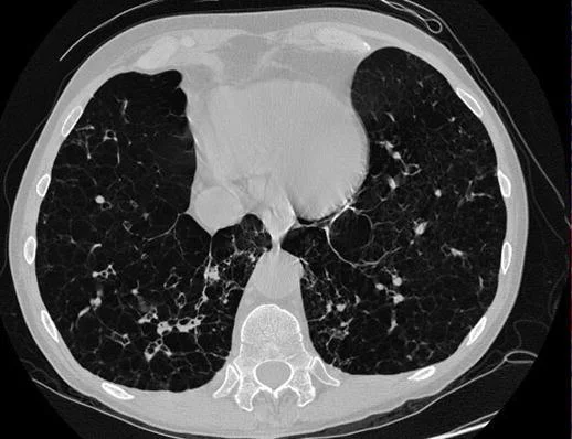 Axiale CT des Thorax im Lungenfenster mit großflächig dunklen, gefäßarmen Arealen und dünnen Restsepten in beiden Lungen.