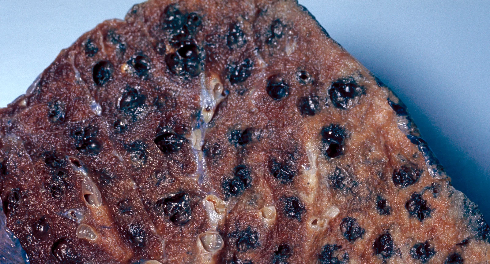 Schnittfläche einer fixierten Raucherlunge mit zahlreichen kleinen, schwarz ausgekleideten Hohlräumen zwischen erhaltenem Lungengewebe.