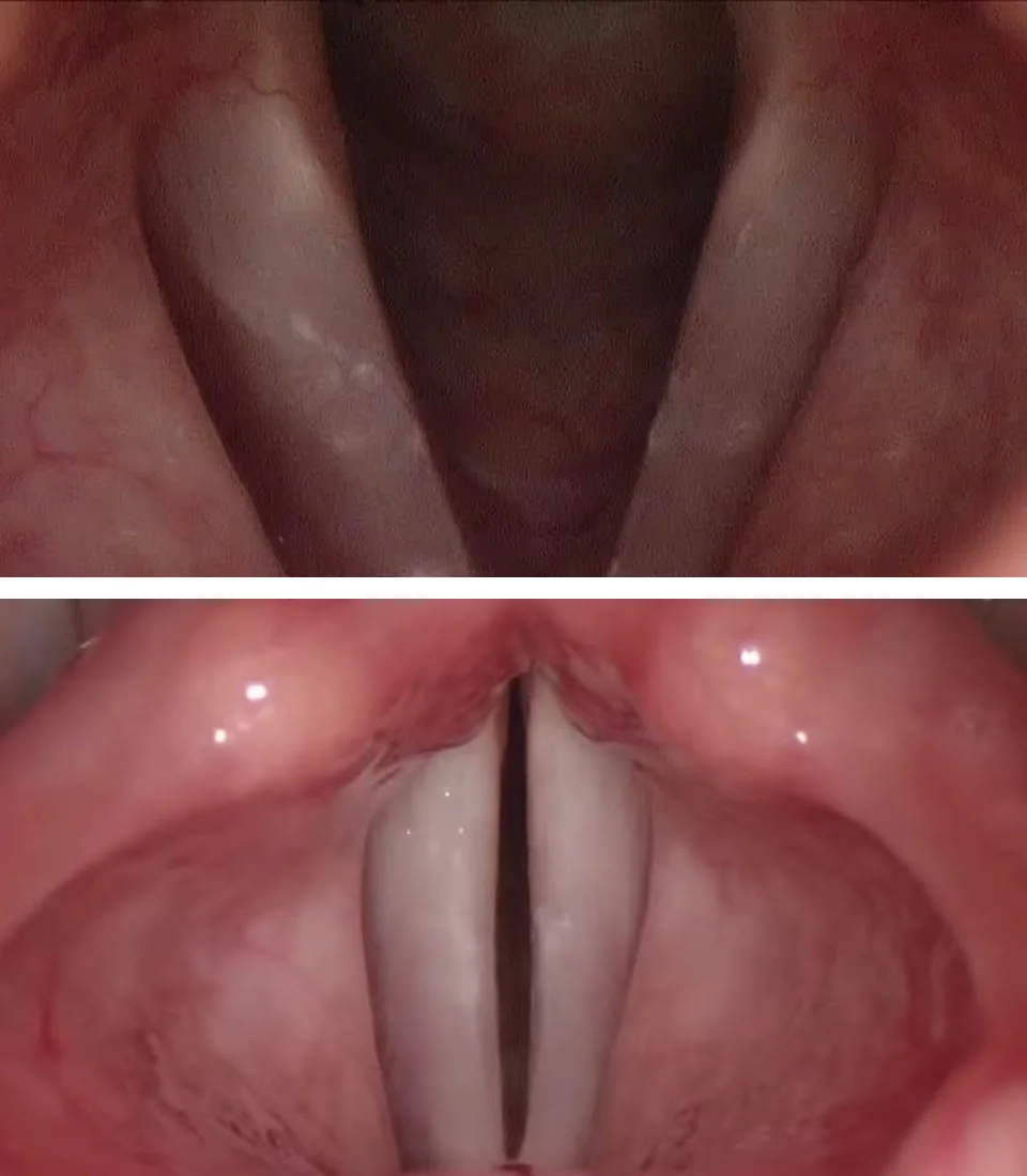 Zwei Aufnahmen aus einer starren Laryngoskopie. Oben sind die Stimmlippen weit auseinandergewichen und die Stimmritze ist offen. Unten liegen die weißlichen Stimmlippen in der Mitte eng aneinander.