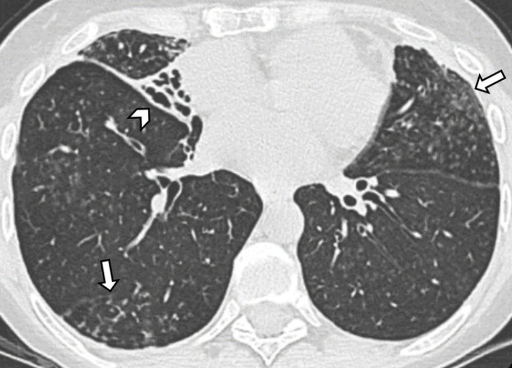 Axiale CT des Thorax im Lungenfenster. Neben dem Herzen ist der Mittellappen geschrumpft und von erweiterten, teils perlschnurartig unregelmäßigen Bronchien durchzogen. In beiden Lungen finden sich kleine, verzweigte Knötchen, markiert durch Pfeile.