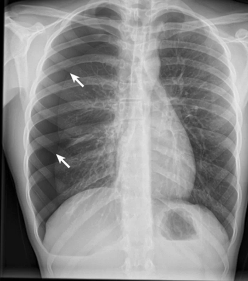 Röntgen-Thorax p.-a. mit rechtsseitigem Pneumothorax: zwei Pfeile zeigen auf die zarte viszerale Pleuralinie, außerhalb davon fehlt die Lungengefäßzeichnung.